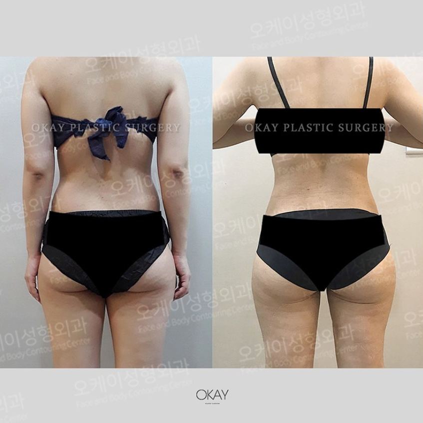 Buttock Fat Grafting: What Makes the Difference in Improving Fat-Graft Retention? image 7