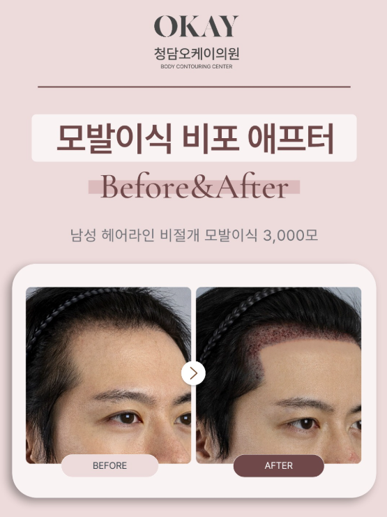 M자모발이식, 심은 머리가 다시 빠질 수도 있을까? 관련 이미지 5