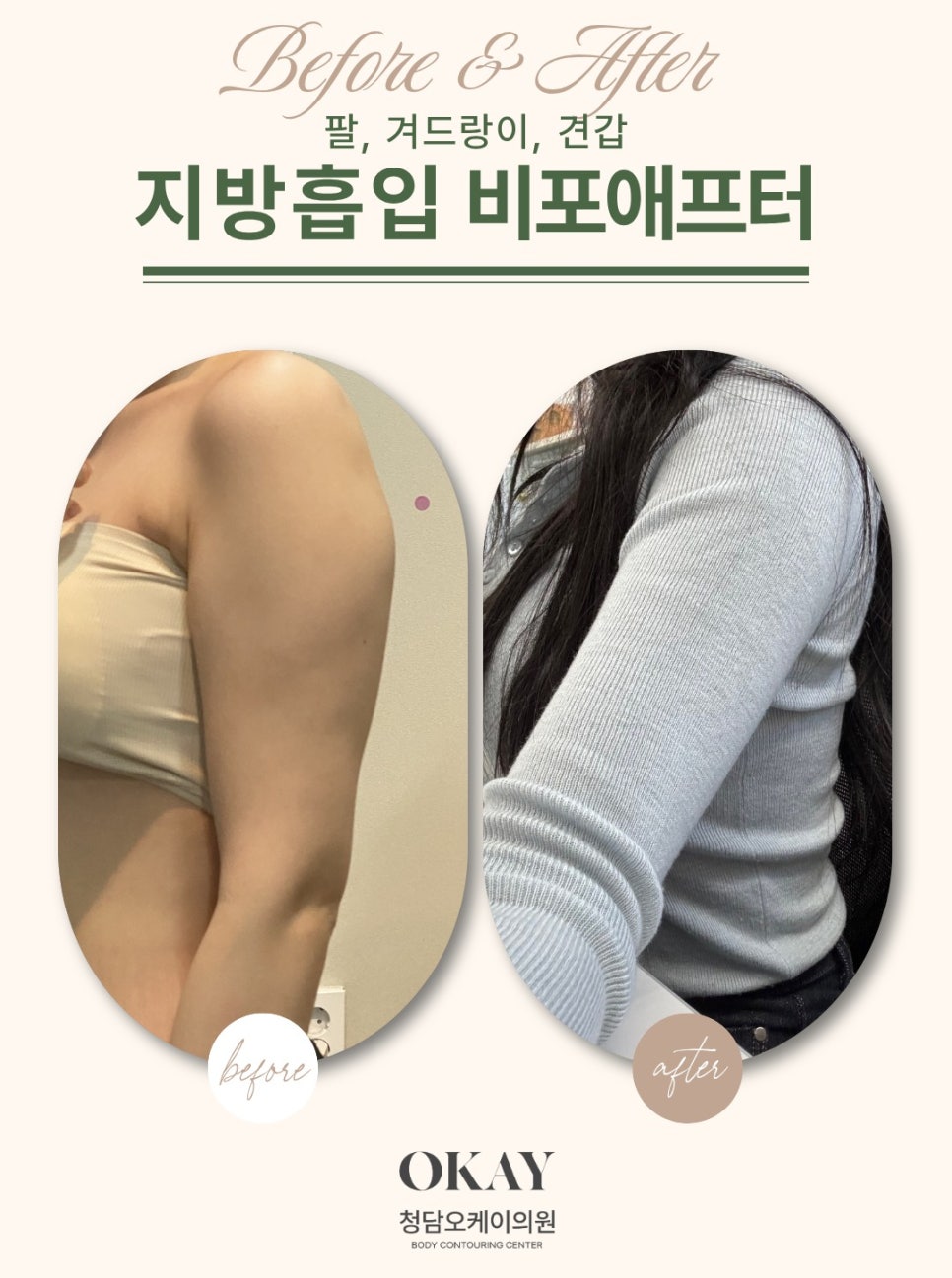 연예인지방흡입, 날씬함보다 중요한 디자인의 차이 관련 이미지 6