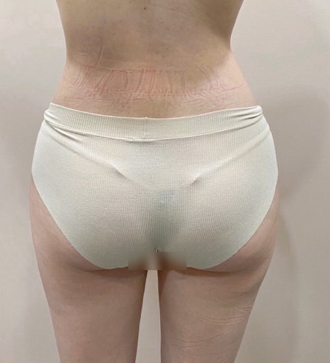 강남지방이식 잘하는곳 찾는다면, 골반 지방이식 효과&middot;생착률&middot;기간 정리 관련 이미지 12