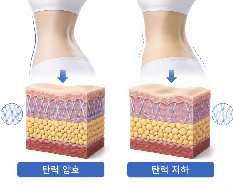 러브핸들지방흡입, 옆구리만 빼면 안 되는 이유 관련 이미지 8