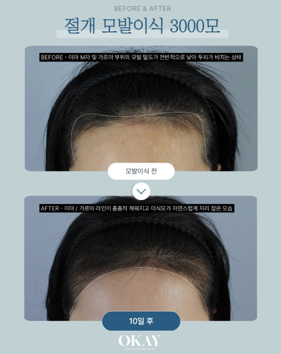 모발이식, 많이 심으면 무조건 풍성해질까요? 관련 이미지 8