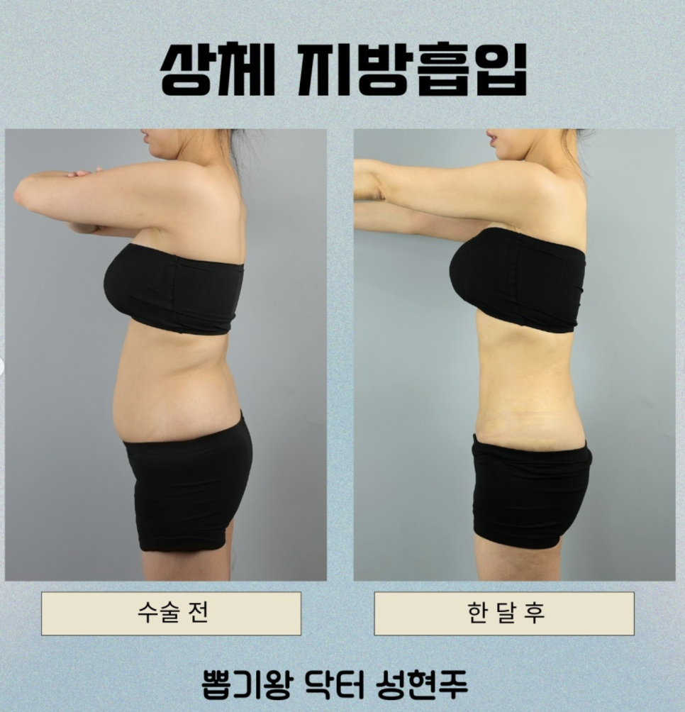 Liposuction Bio-Bond Care: First, Understand Why It Becomes Hard image 3