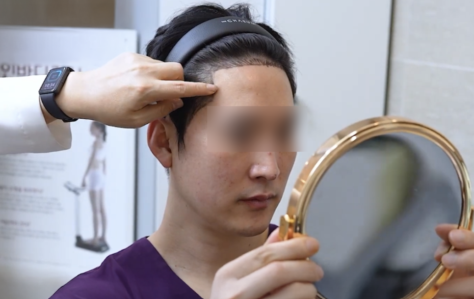 강남모발이식병원, 수술하면 탈모약은 끊어도 될까 관련 이미지 6