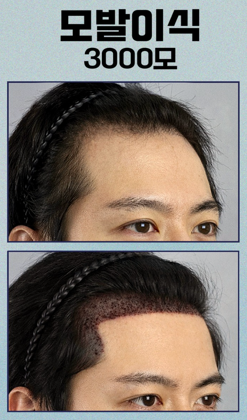 Is 3,000 Grafts Enough for a Hair Transplant? A Complete Guide from Design to Coverage image 9