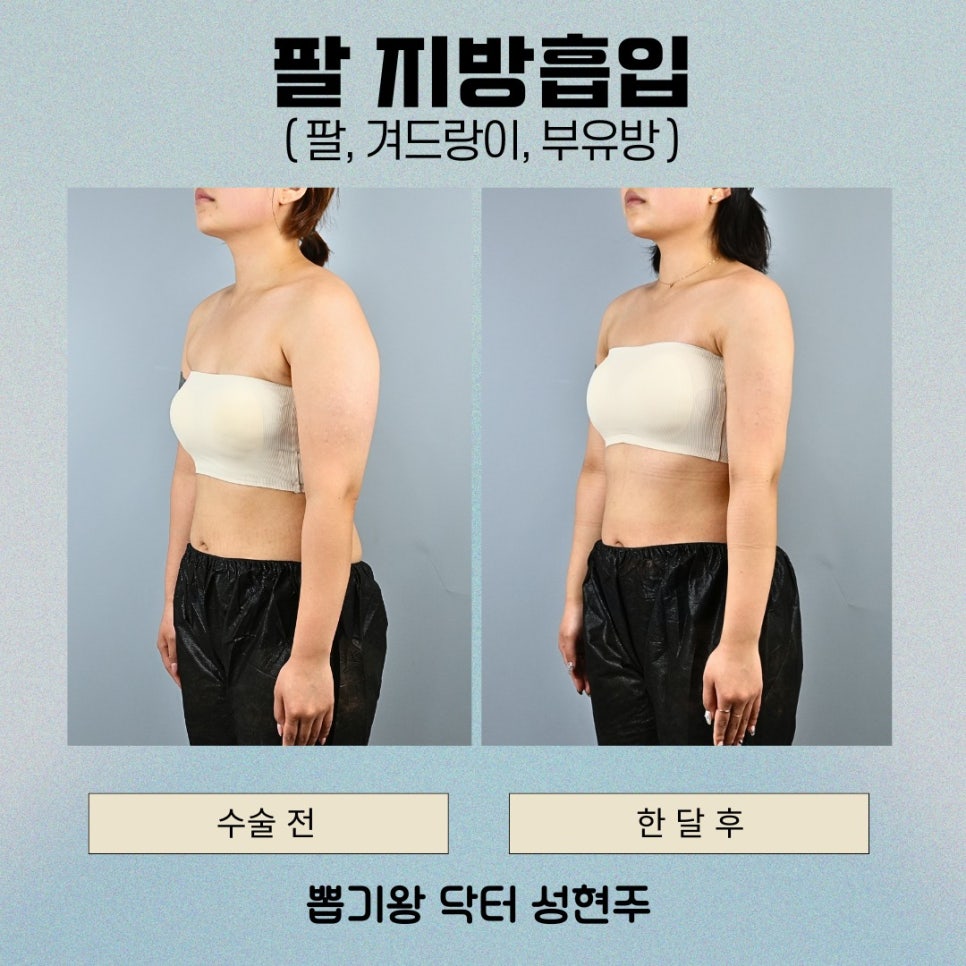 팔뚝지방흡입후관리, 결과를 오래 유지하려면 이것부터 확인하세요 관련 이미지 4