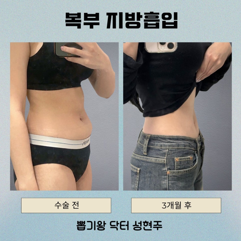 옆구리지방흡입, 허리라인 디자인이 중요한 이유 관련 이미지 6