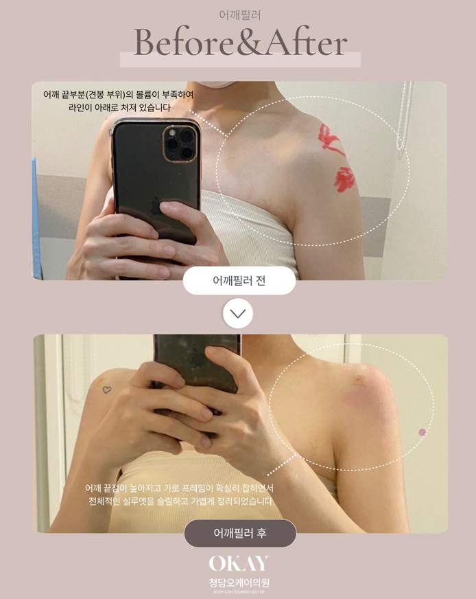 청담역성형외과 어깨필러, 어깨라인이 예뻐 보이는 사람들의 공통점 관련 이미지 7