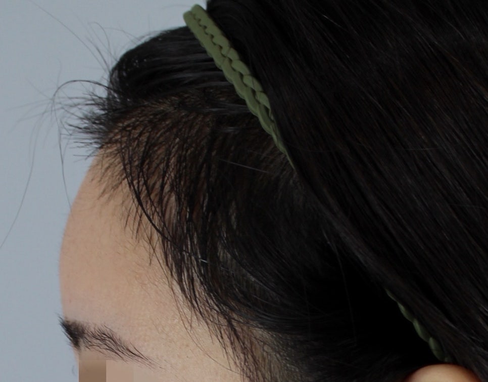 Why Are the Results of Apgujeong Female Hairline Hair Transplant Different? Differences by Type, Graft Survival Rate, and Naturalness image 4