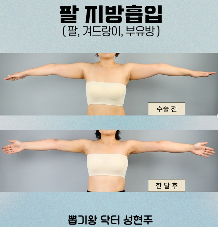 지방흡입 내돈내산, 처짐부터 멍·회복기간까지 솔직하게 알려드립니다 관련 이미지 7