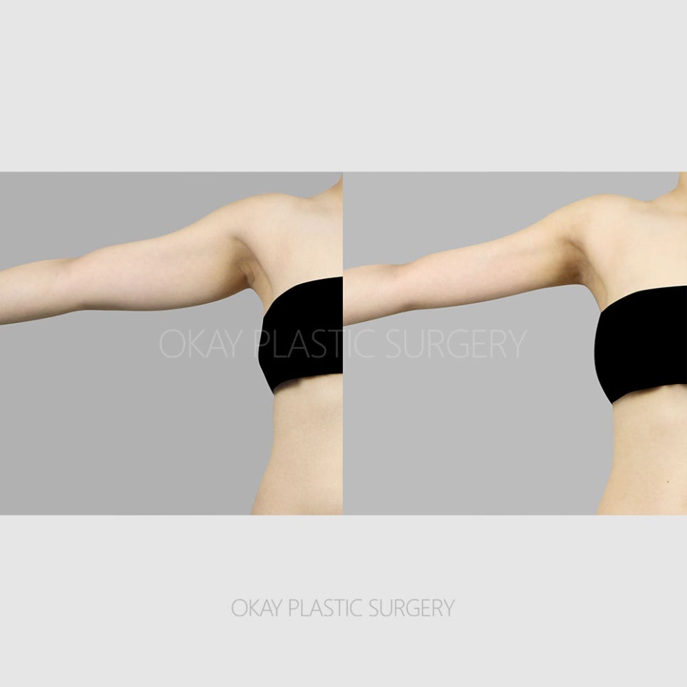 팔뚝지방흡입후관리 어떻게 해야 할까? 붓기&middot;통증&middot;멍 줄이는 회복 기간 관리 방법 정리 관련 이미지 5