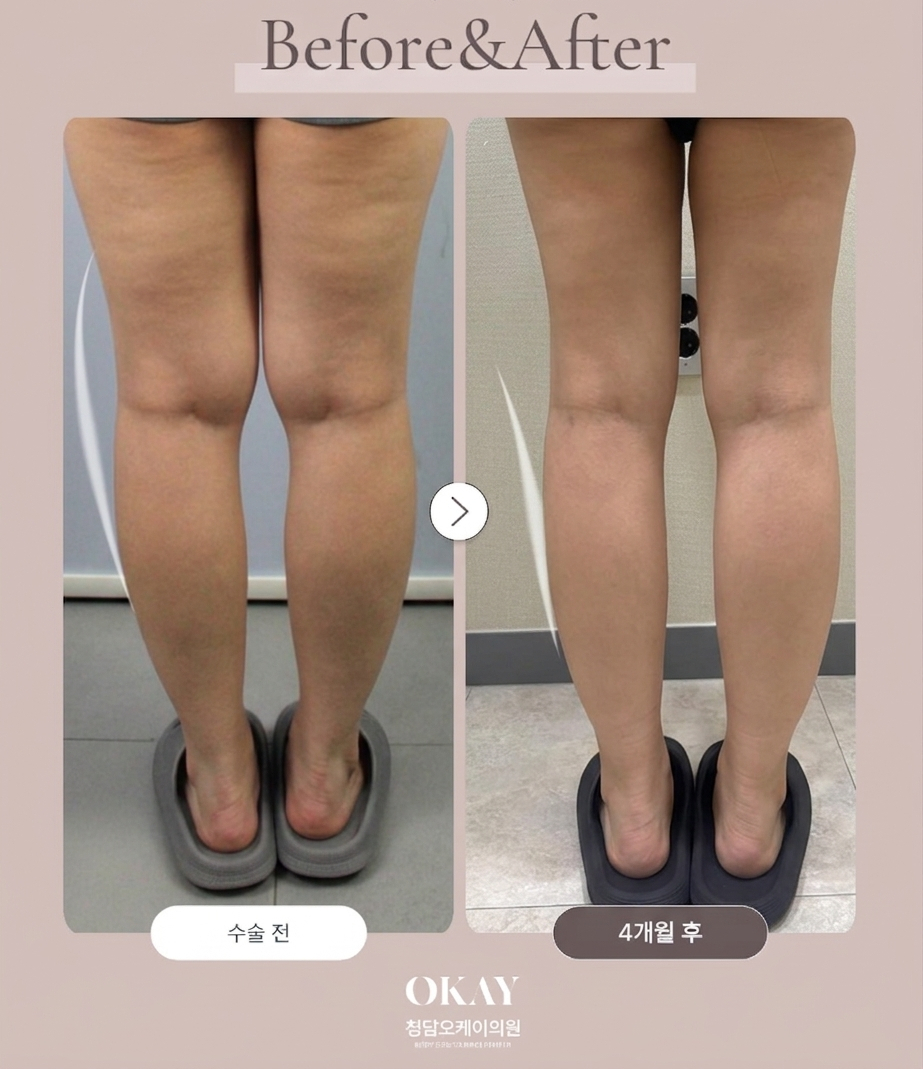 Calf Liposuction: There Is Something More Important Than the Amount of Fat image 7