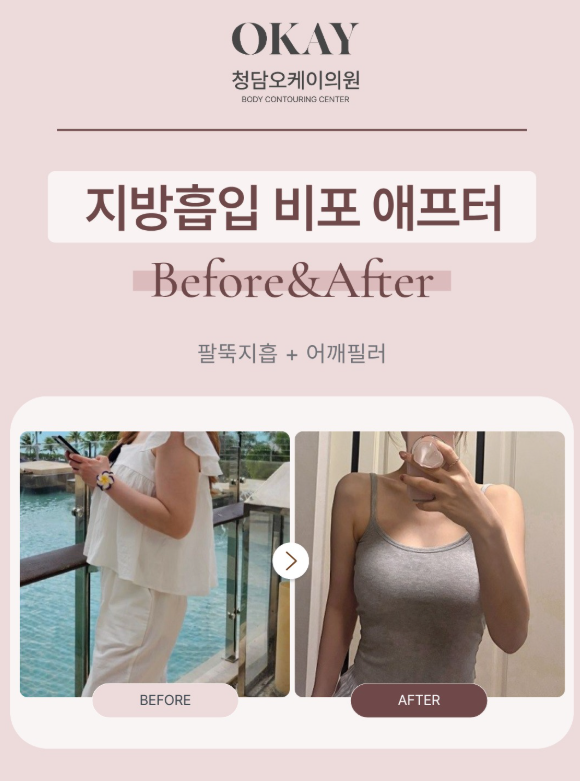 팔지흡 압박복 기간, 언제까지 입어야 할까요? 붓기와 회복기간 총정리 관련 이미지 8