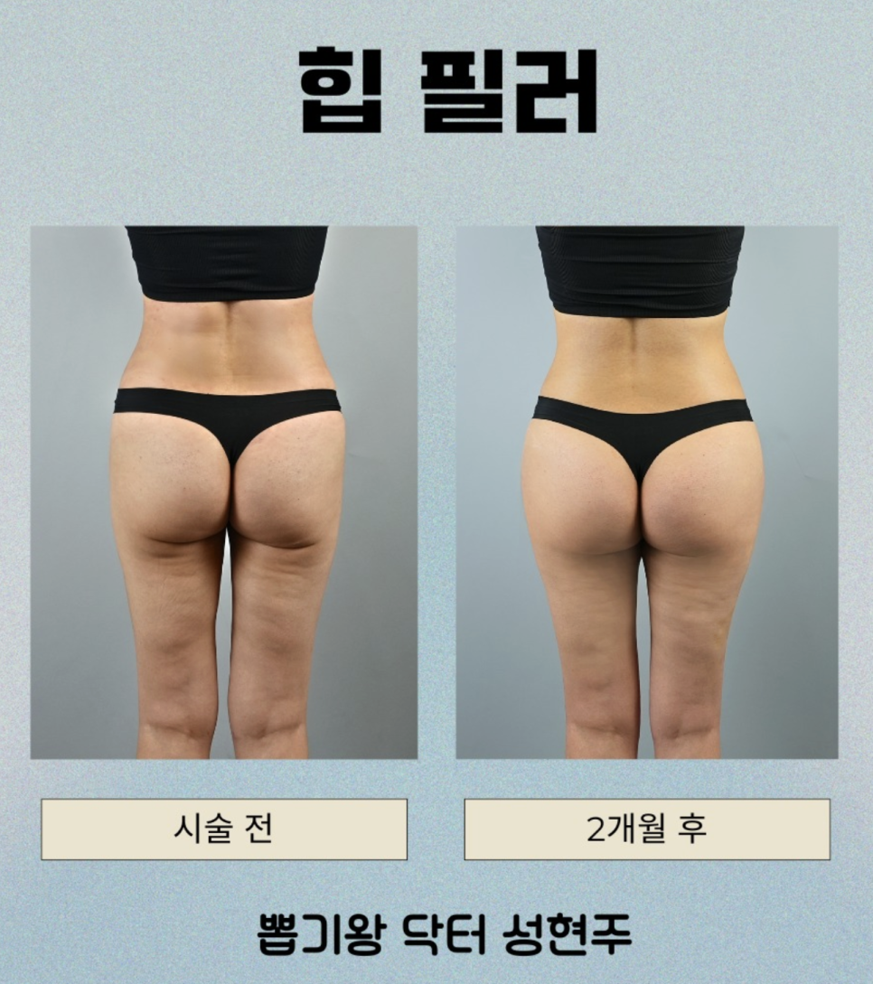 엉덩이필러후기, 부작용·유지기간·만족도까지 확인해보세요 관련 이미지 9
