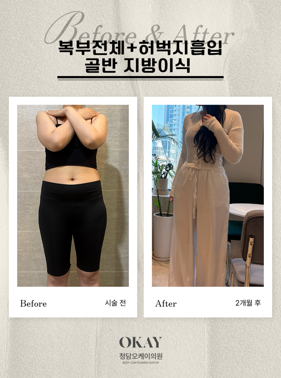 복부지방흡입 후 만족도가 갈리는 이유, 수술보다 중요한 건 따로 있습니다 관련 이미지 6