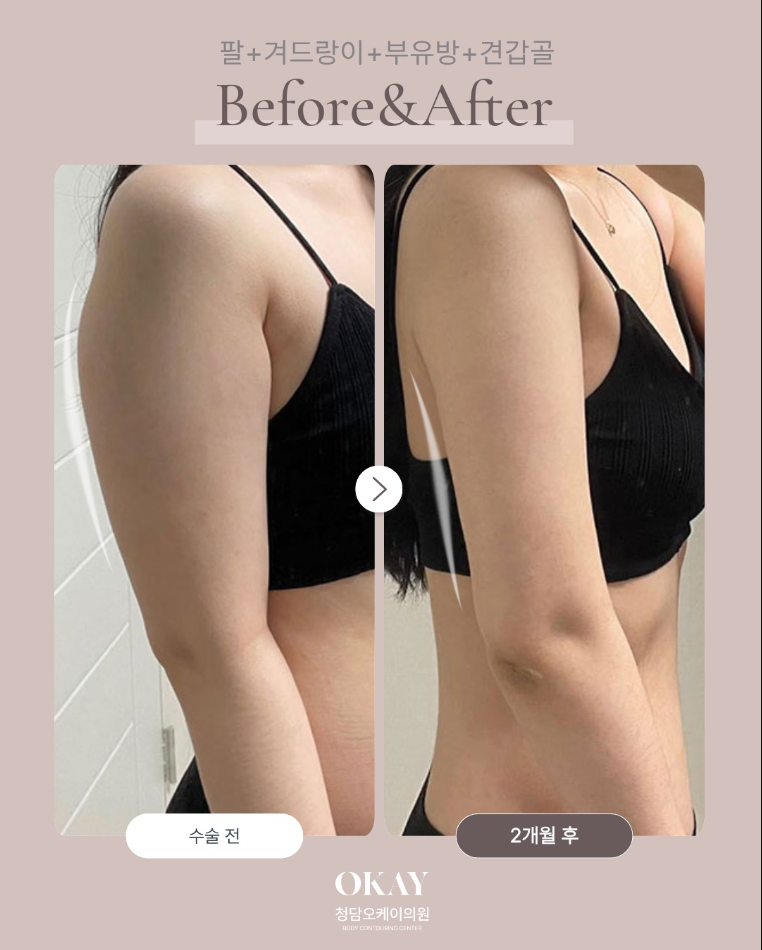 Post-Arm Liposuction Care: When Does Swelling Go Down, and How Long Should You Wear Compression Garments? image 5