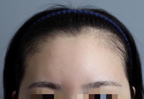 강남 여자모발이식잘하는곳 3000모가 맞을까? 비용&middot;통증&middot;생착률&middot;디자인과 사후관리 관련 이미지 6