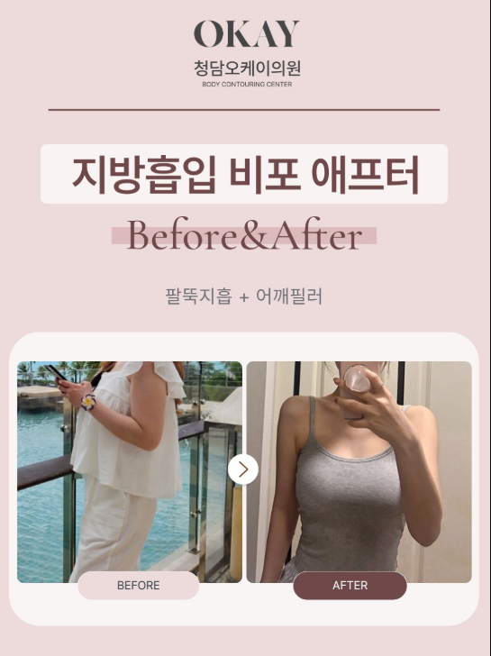 Gangnam Liposuction: Designing a Beautiful Silhouette Matters More Than Fat Removal image 9
