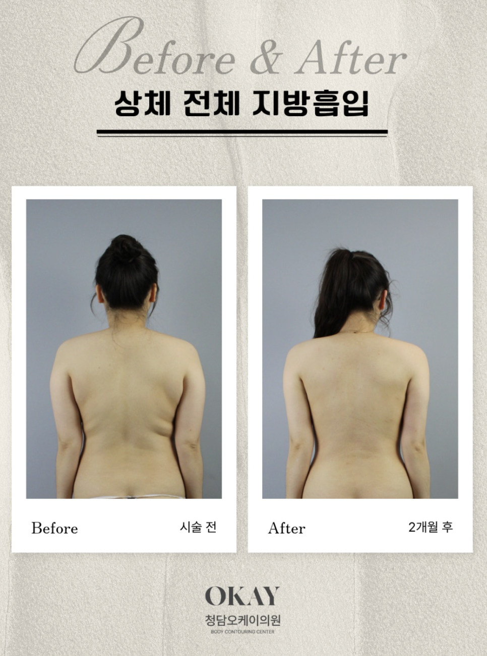 강남성형외과 지방흡입, 똑같은 지방을 빼도 결과가 다른 이유 관련 이미지 10