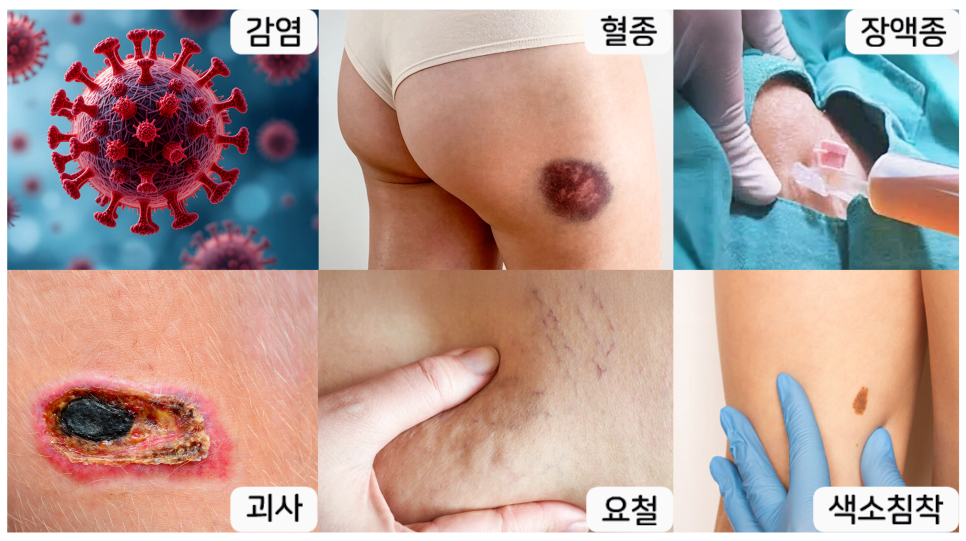 [청담오케이의원] 지방흡입, 정말 안전한 수술일까? 관련 이미지 6