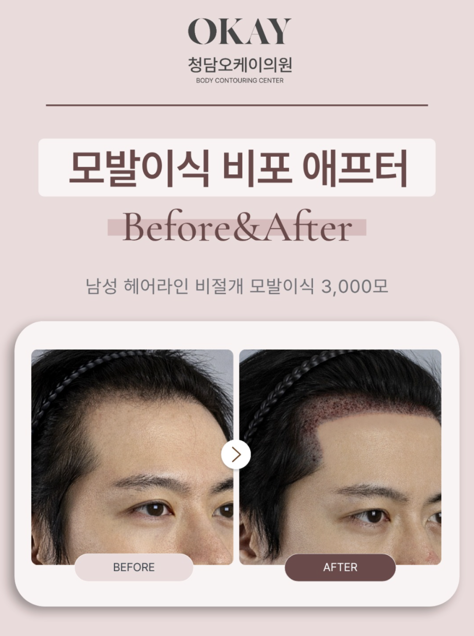 강남탈모병원, 언제부터 모발이식을 고려해야 할까요? 관련 이미지 5