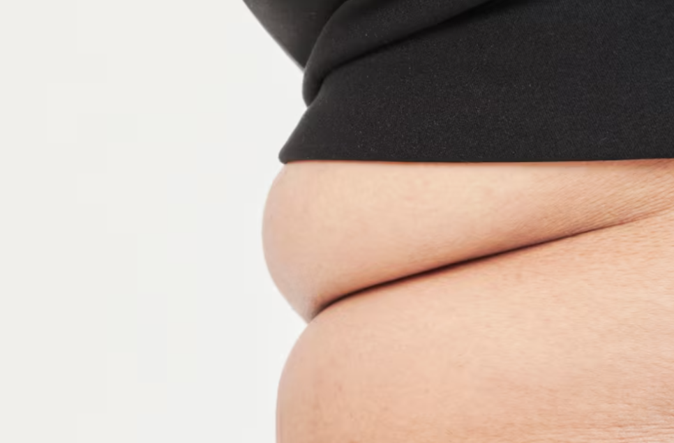 남자지방흡입, 술배처럼 나온 복부 어디까지 줄일 수 있을까요? 관련 이미지 7
