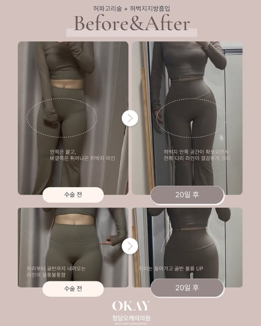 Cheongdam-dong Plastic Surgery Clinic: This Is More Important Than the Amount Removed in Thigh Liposuction image 8