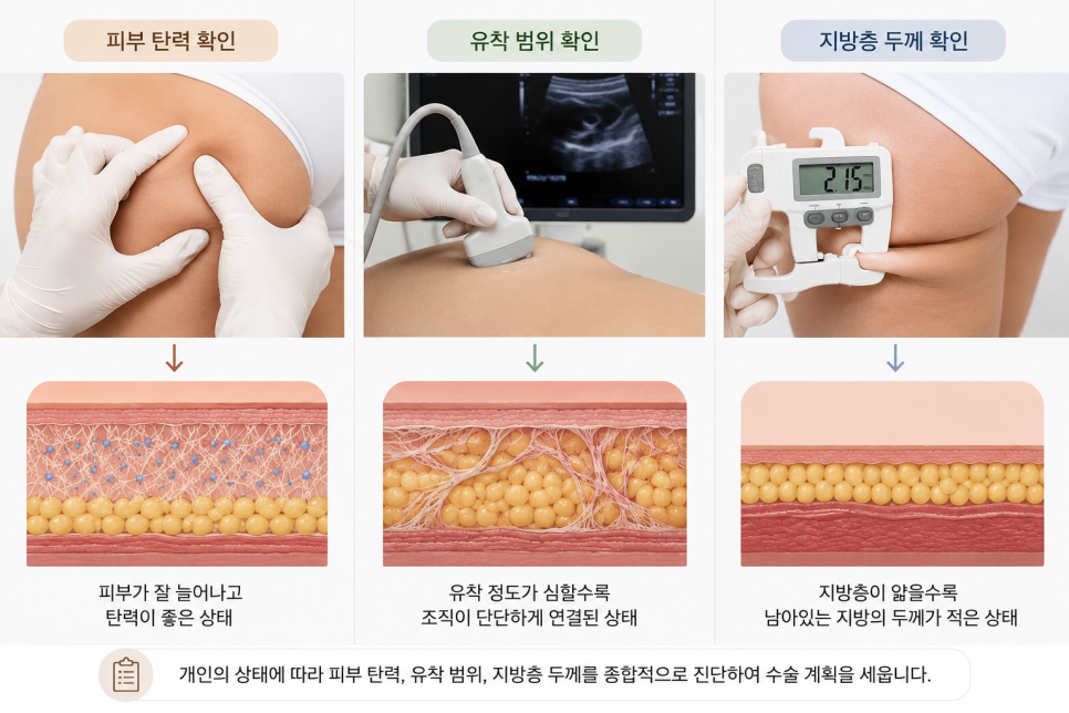 If You’re Looking for a Clinic Skilled in Revision Liposuction, Why You Should Never Simply Undergo Liposuction Again image 8