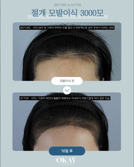여자헤어라인모발이식 효과 언제부터 보일까? 생착 시기&middot;회복기간 설명 관련 이미지 7