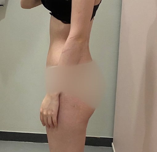 압구정 허벅지지방흡입 효과, 기대만큼 나올까? 회복기간&middot;멍&middot;붓기&middot;부작용과 주의할 점까지 관련 이미지 3