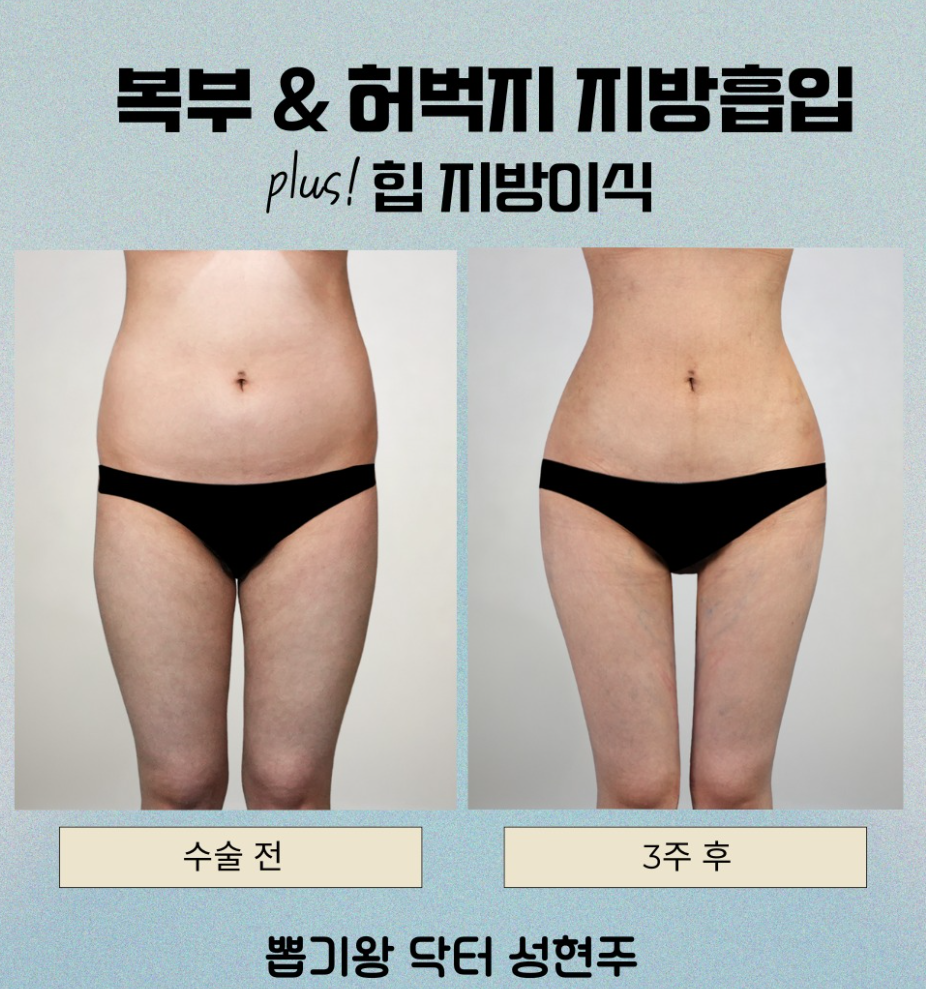 How to Lose Abdominal Fat: When Is Liposuction Needed for Belly Fat That Dieting Can't Remove? image 6