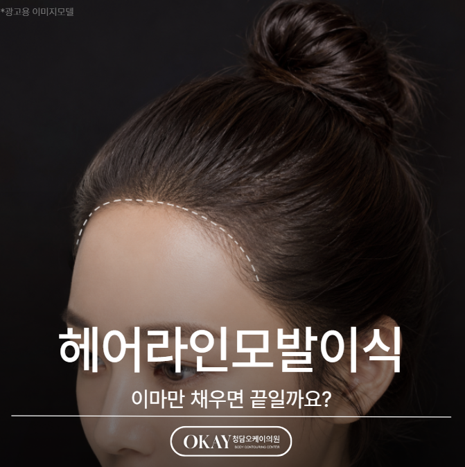 헤어라인모발이식, 이마만 채우면 끝일까요? 관련 이미지 1