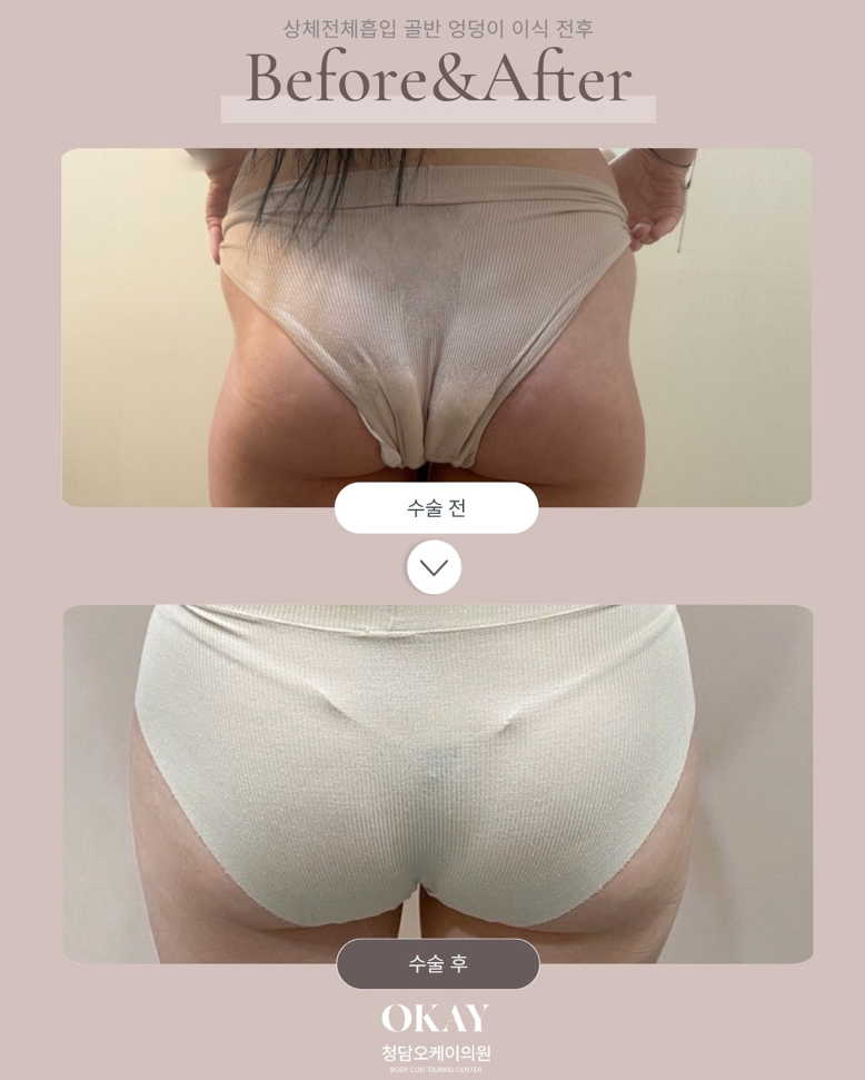 Buttock Fat Grafting: What Makes the Difference in Improving Fat-Graft Retention? image 4