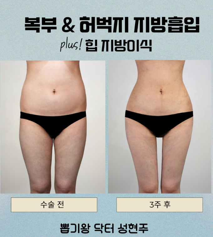 허리살빼기, 지방흡입 후 허리라인은 얼마나 달라질까요? 관련 이미지 7