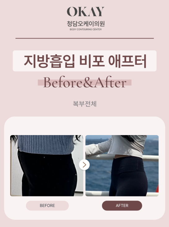 강남역지흡잘하는곳 찾기 전, 체형에 맞는 디자인이 중요한 이유 관련 이미지 8