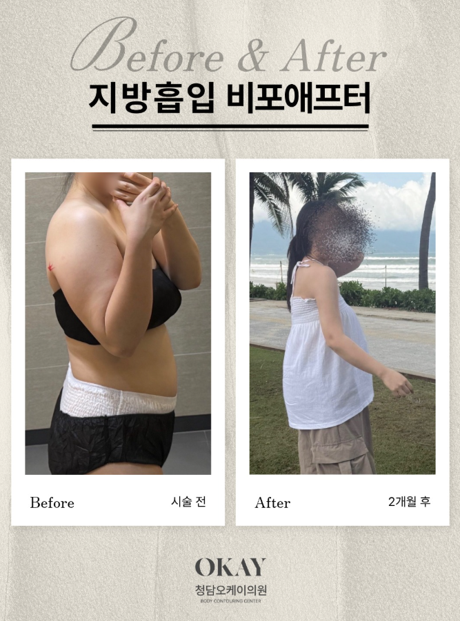 겨드랑이부유방 제거, 지방흡입으로 해결할 수 있을까요? 관련 이미지 5