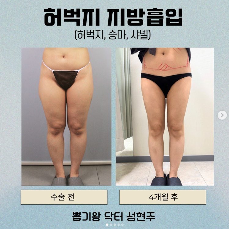 지방흡입 재수술, 처음보다 더 신중해야 하는 이유 관련 이미지 10