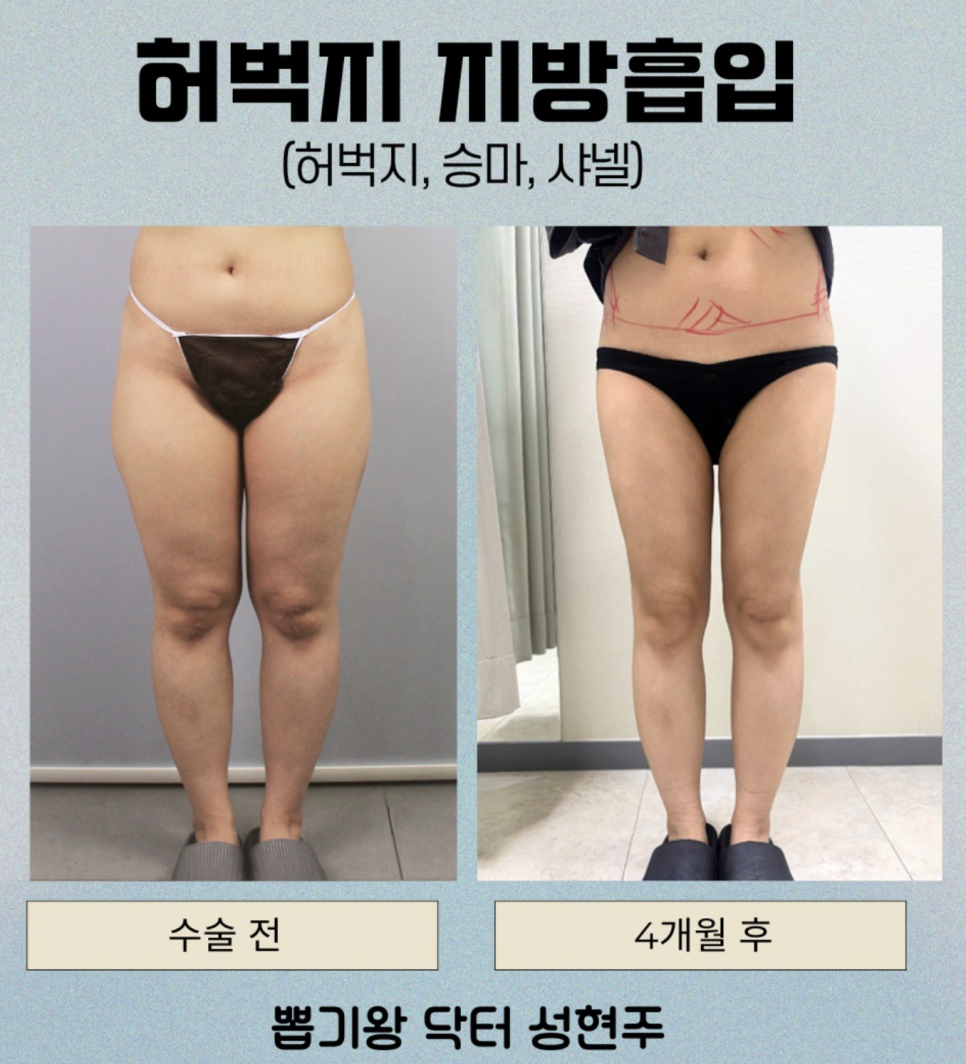 안쪽허벅지지방흡입, 바지 핏이 달라지는 핵심은 이것입니다 관련 이미지 8