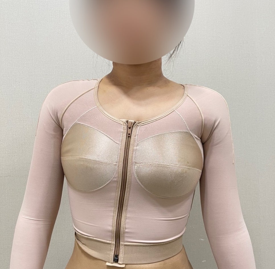 Upper Body Liposuction Pain vs Swelling: Which Is Harder? A Comparison Based on Real Experience image 8