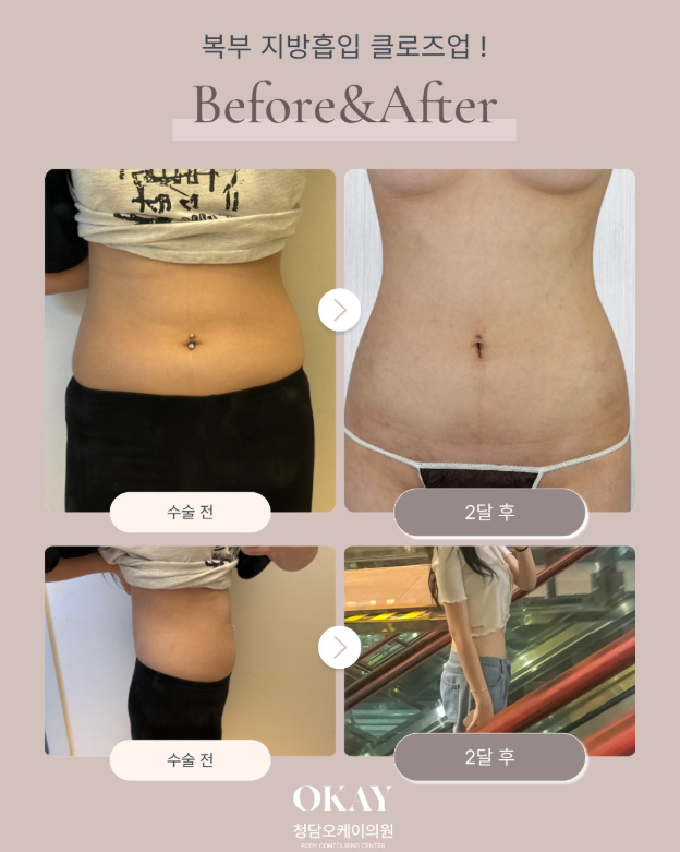Liposuction for the Love Handles: The Decisive Difference That Defines the Waistline image 10