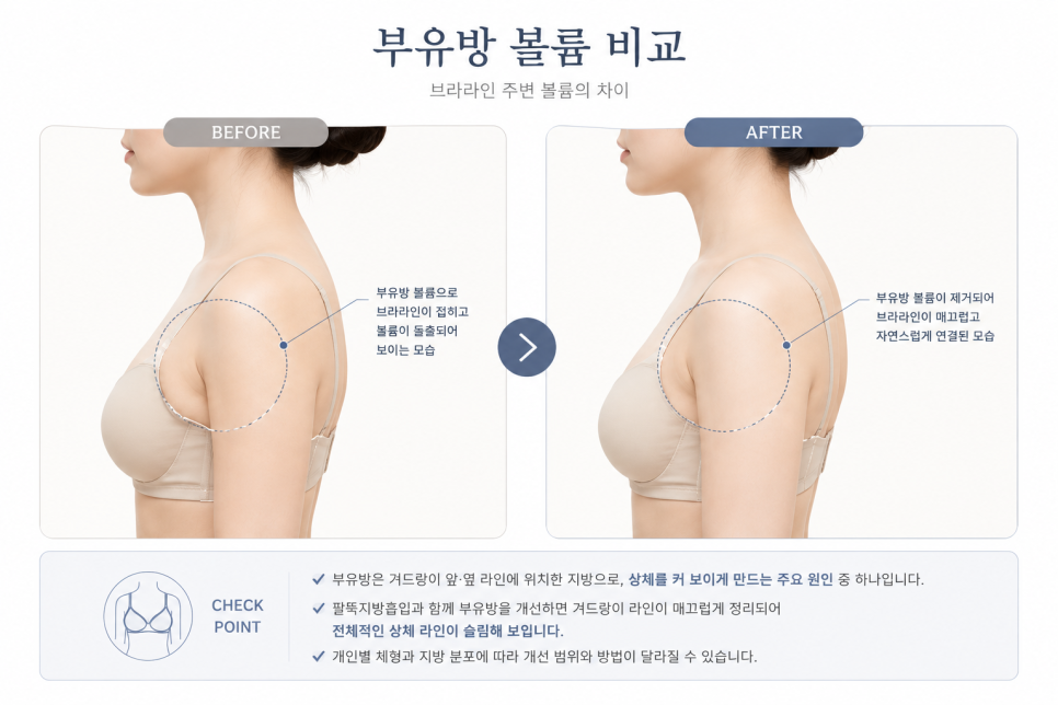 팔뚝지방흡입, 승모근&middot;부유방까지 함께 봐야 하는 이유 관련 이미지 7