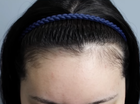 Can Hair Transplant Graft Survival Rates Differ Between Non-Excision and Excision Methods? Comparing Differences in Recovery Management image 11