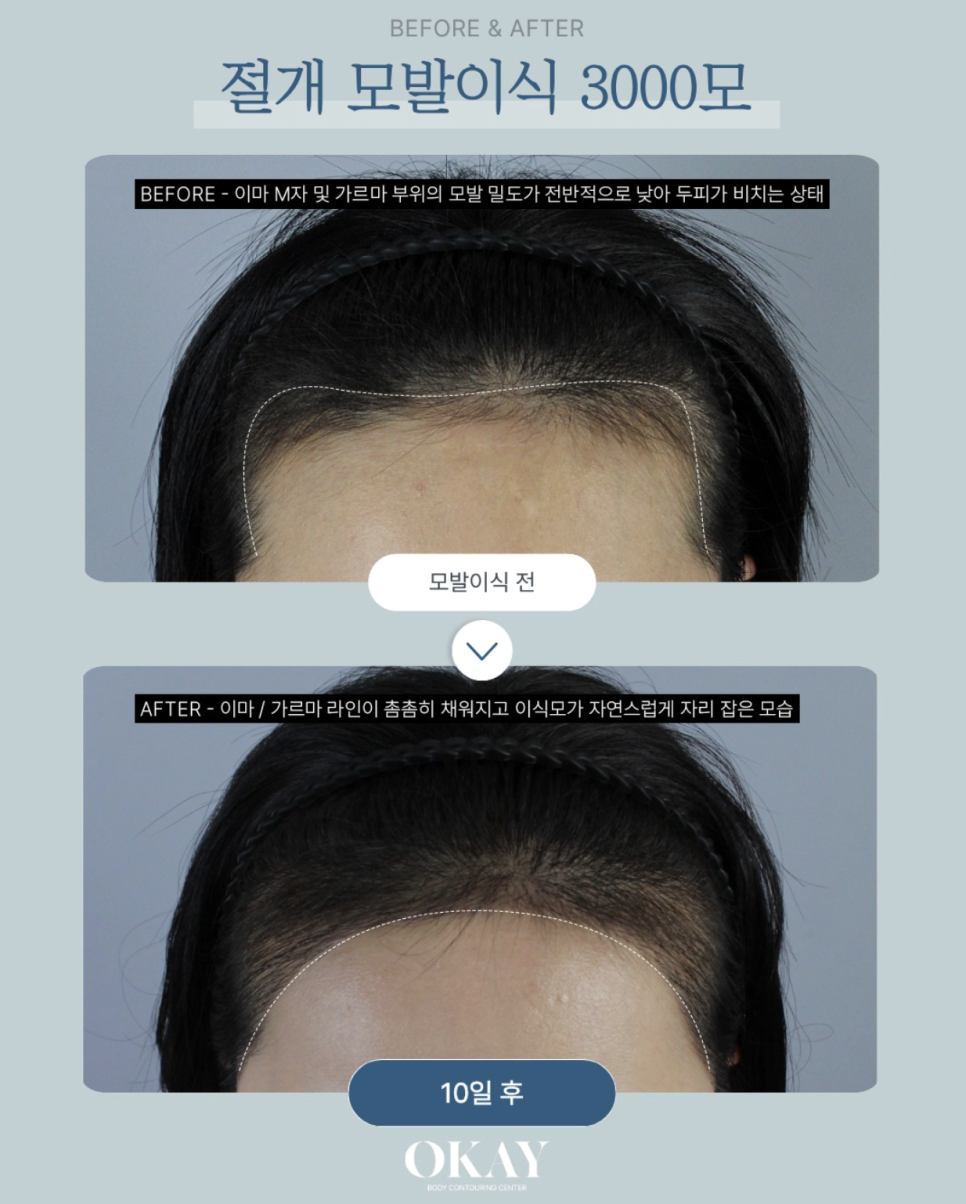 M-Shaped Hairline Hair Transplantation: Why Women Are Seeking It First image 10
