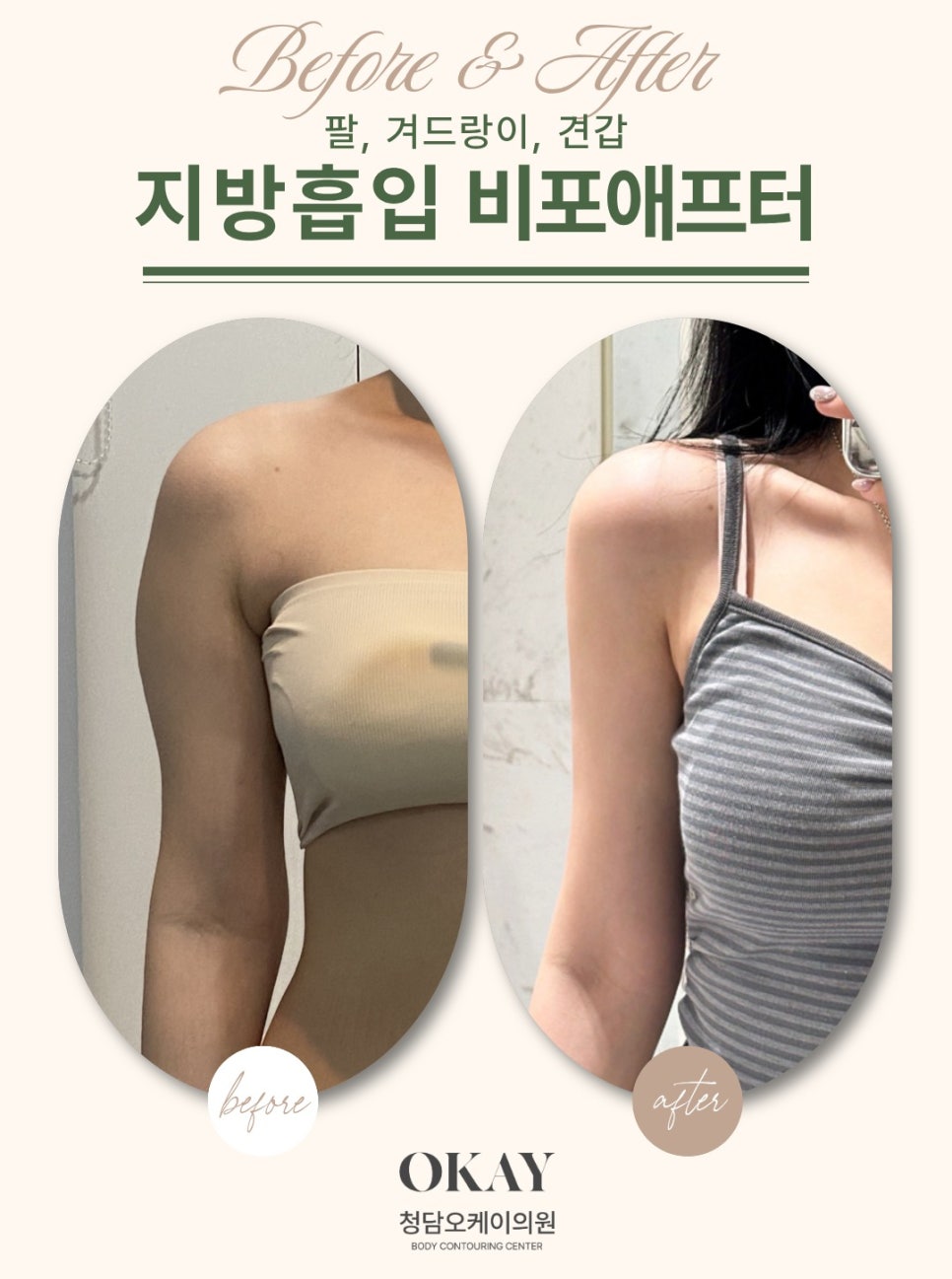 팔뚝지방흡입, 승모근&middot;부유방까지 함께 봐야 하는 이유 관련 이미지 6