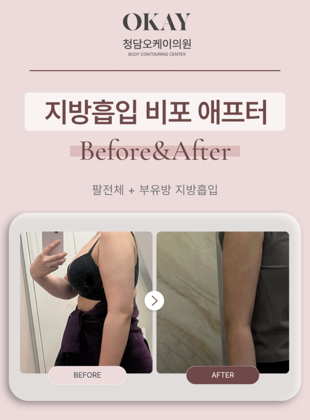 부유방제거수술, 살을 빼도 겨드랑이가 그대로라면? 관련 이미지 7