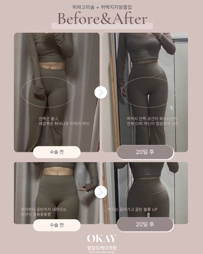 승마살지방흡입 효과 얼마나 다를까? 허벅지 안쪽&middot;바깥쪽 변화 기준 정리 관련 이미지 7