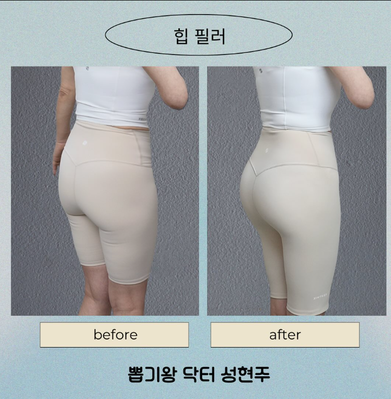 힙딥필러, 땅콩골반이 스트레스라면? 전후 변화&middot;용량&middot;유지기간까지 정리 관련 이미지 6