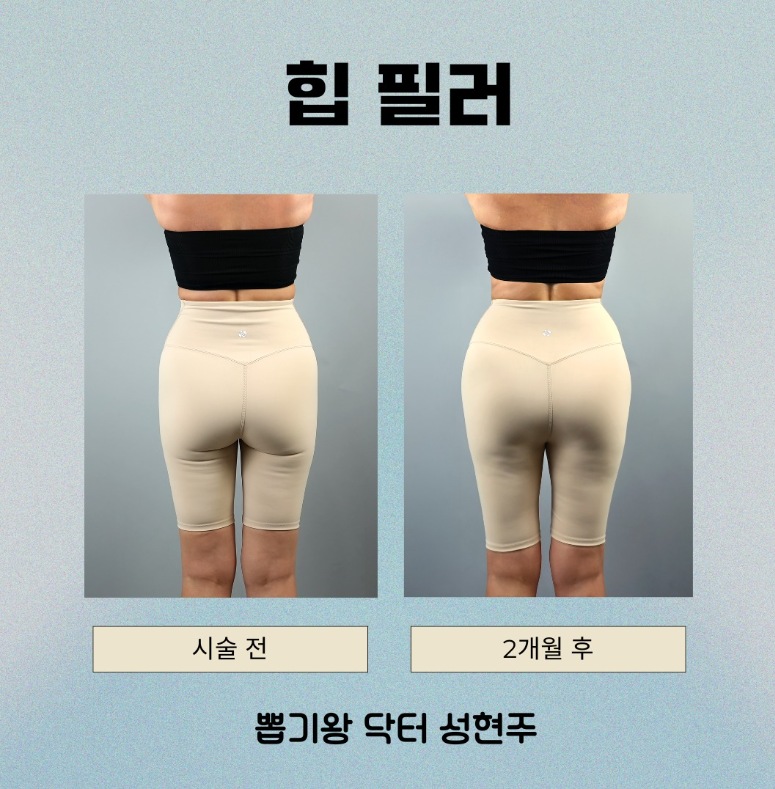 힙딥필러, 땅콩골반이 스트레스라면? 전후 변화&middot;용량&middot;유지기간까지 정리 관련 이미지 8