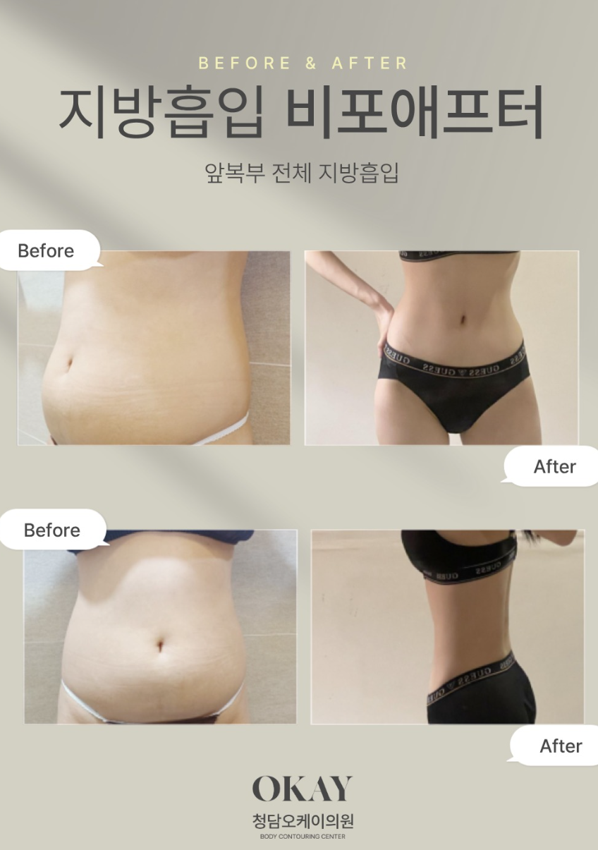뱃살지흡 후기, 아랫배부터 옆구리까지 어디까지 달라질까요? 관련 이미지 5