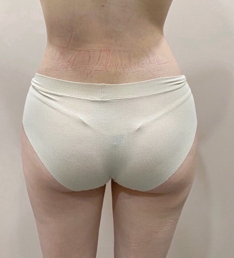 골반지방이식 후 부작용, 생각보다 흔한 케이스는 이것입니다 관련 이미지 6